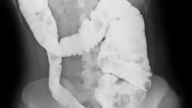 Mik a Crohn-betegség tünetei? Hogyan diagnosztizálják?