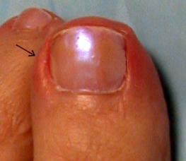 A köröm ujjába emelkedett: az okok és a kezelés