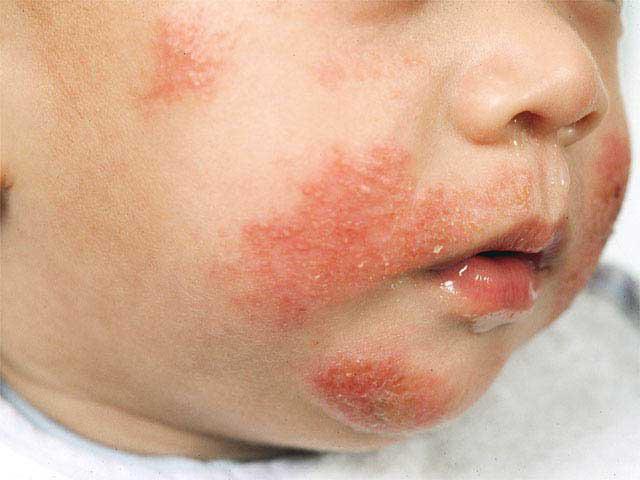 atopiás dermatitis gyermekekben
