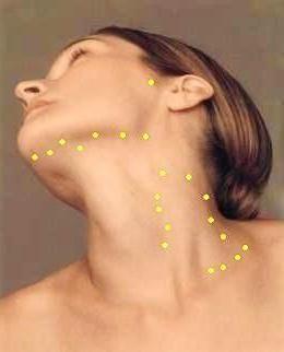 A lymphonodus a nyakán gyulladt, mit kell tenni, vagy először?